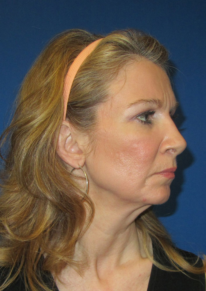 Facelift Before & After Photo #7