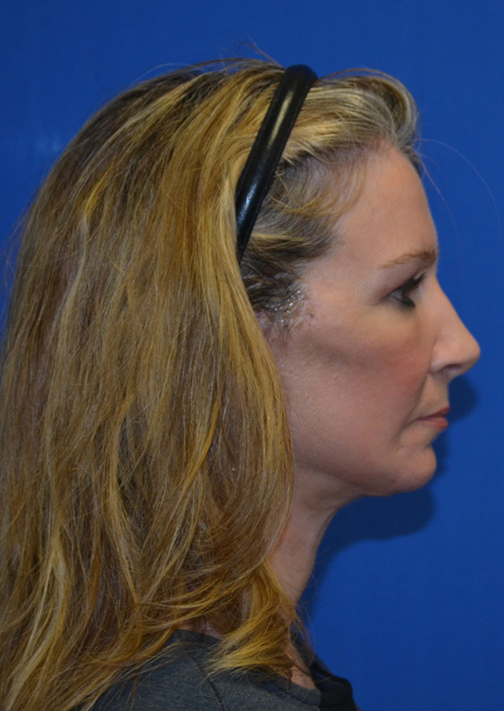 Facelift Before & After Photo #8