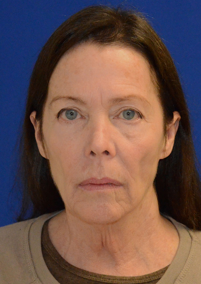 Facelift Before & After Photo #9