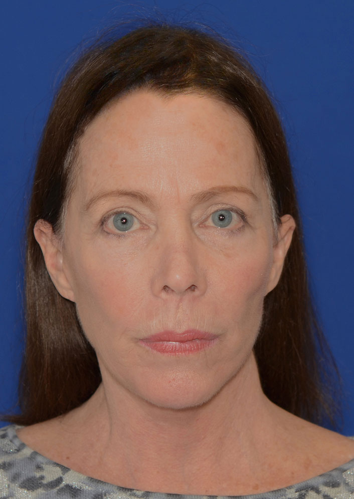 Facelift Before & After Photo #10