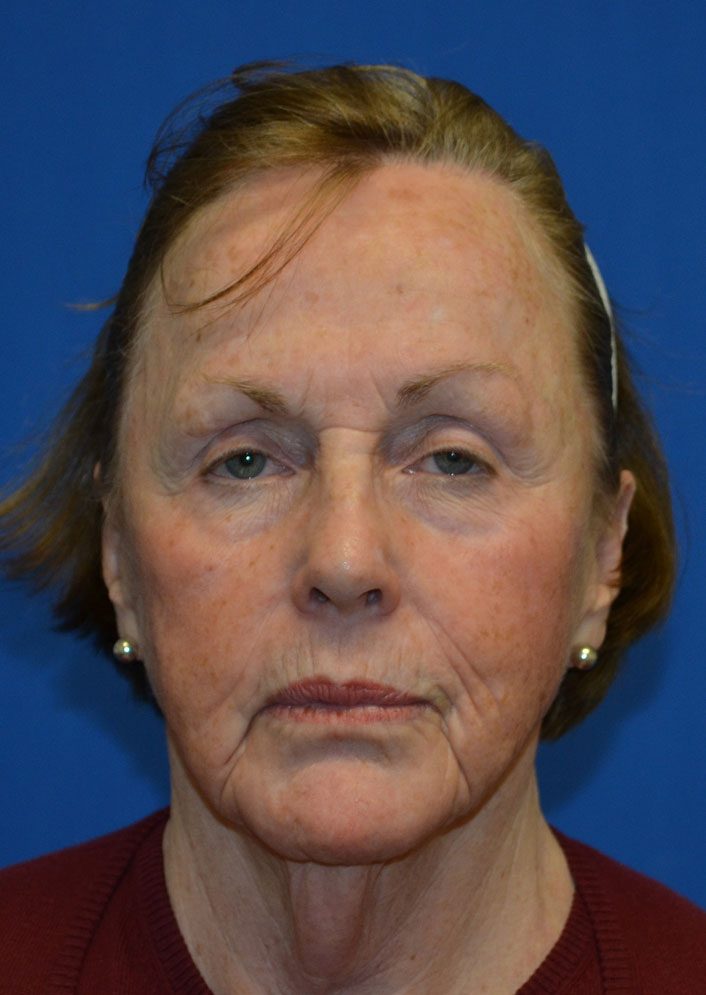 Facelift Before & After Photo #9