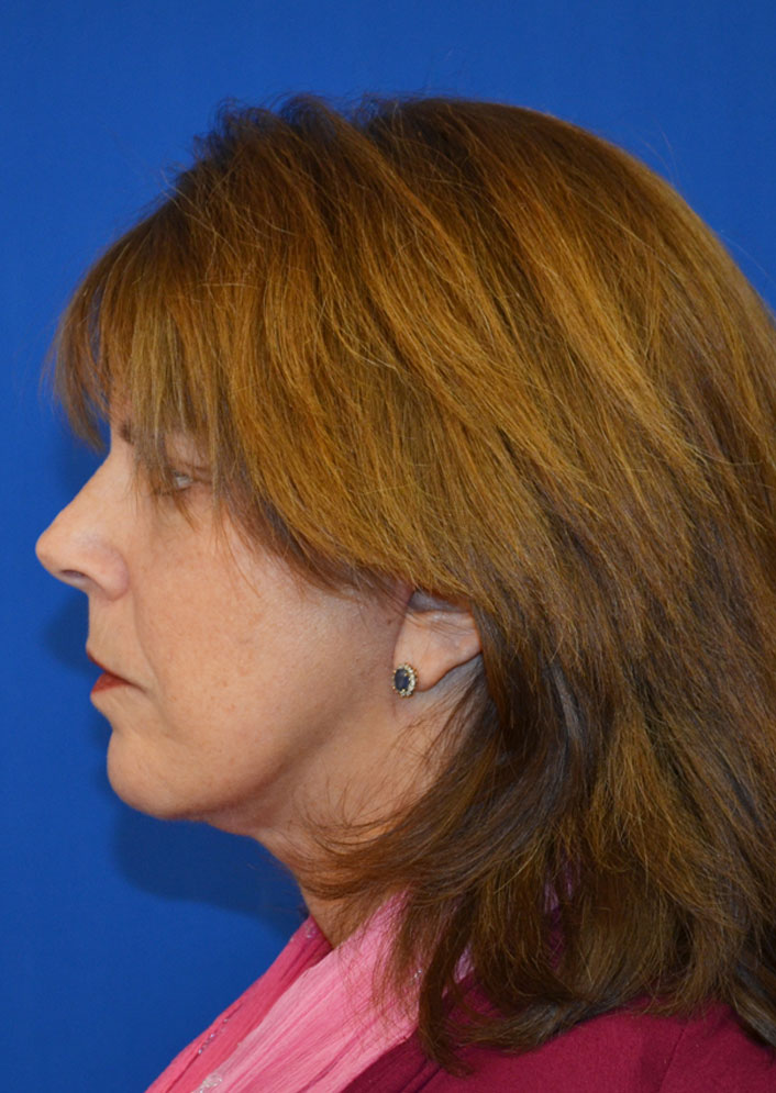 Facelift Before & After Photo #6