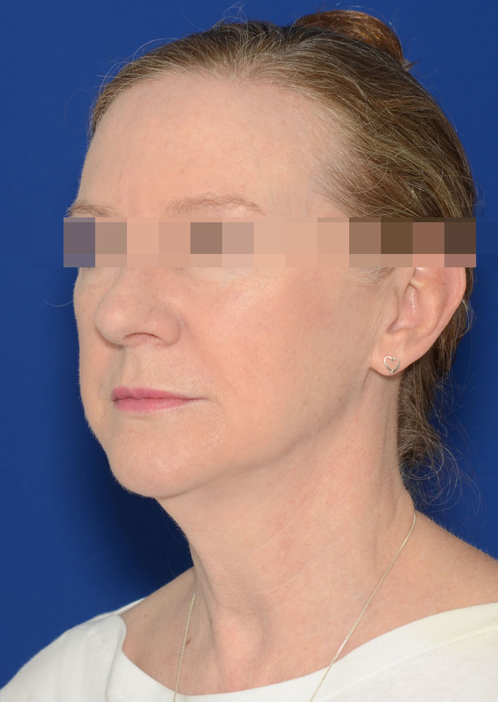 Facelift Before & After Photo #1
