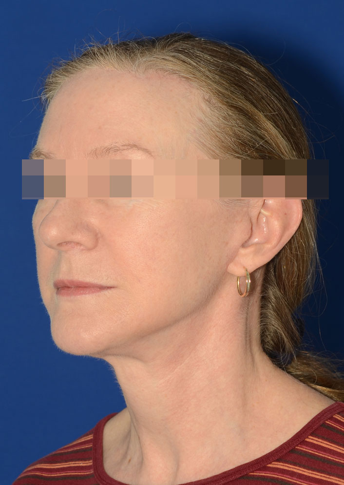 Facelift Before & After Photo #2