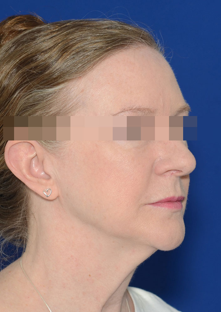 Facelift Before & After Photo #3