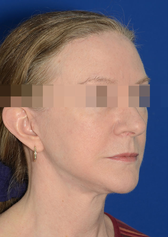 Facelift Before & After Photo #4