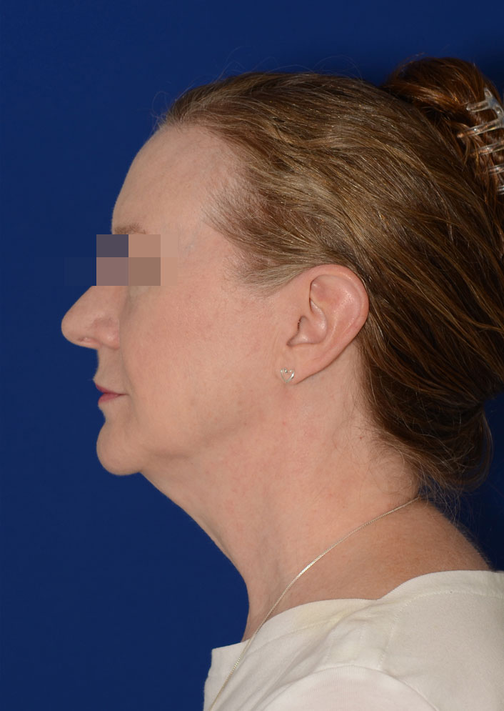 Facelift Before & After Photo #5