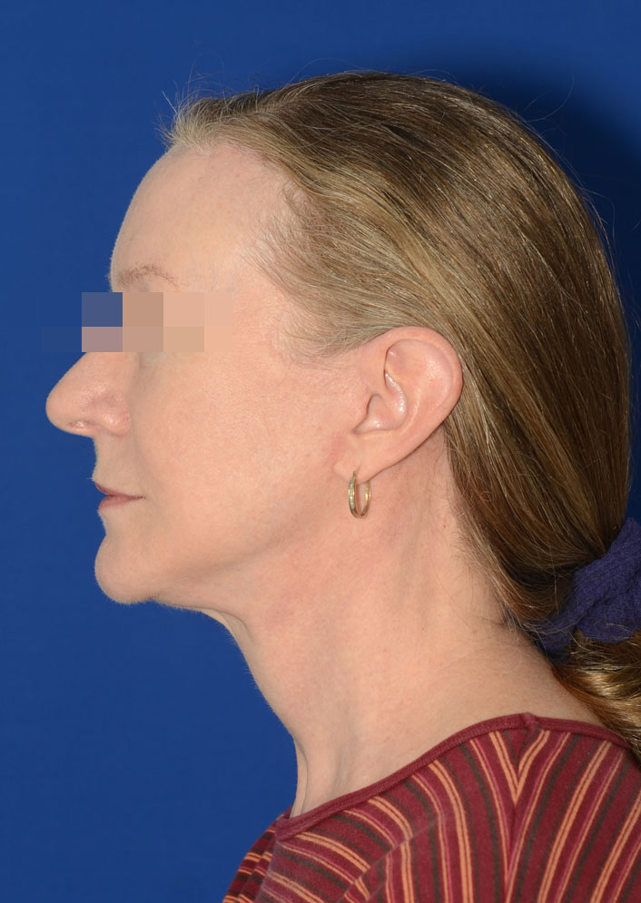 Facelift Before & After Photo #6
