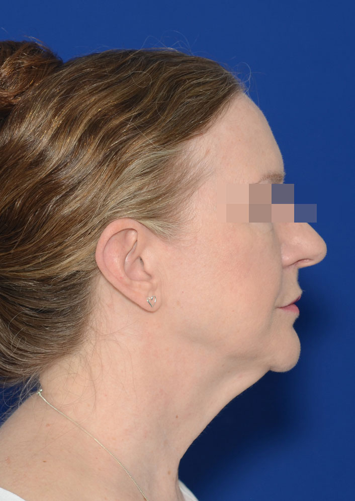 Facelift Before & After Photo #7
