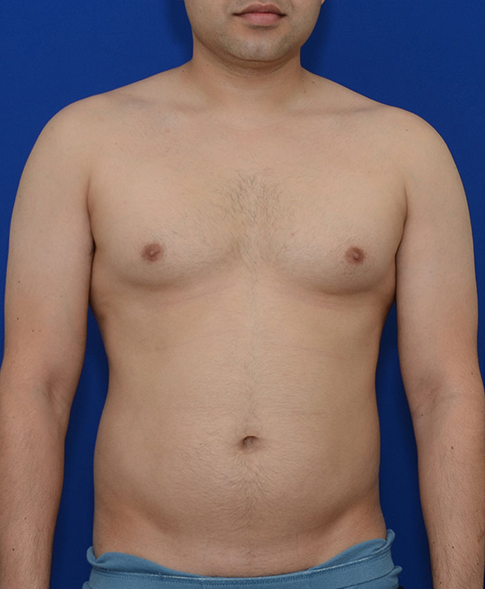 Liposuction Before & After Photo #1
