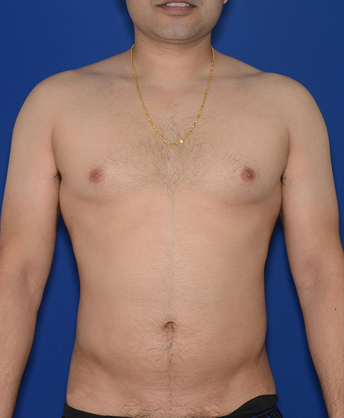 Liposuction Before & After Photo #2