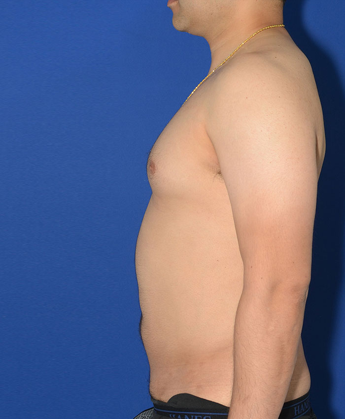 Liposuction Before & After Photo #4