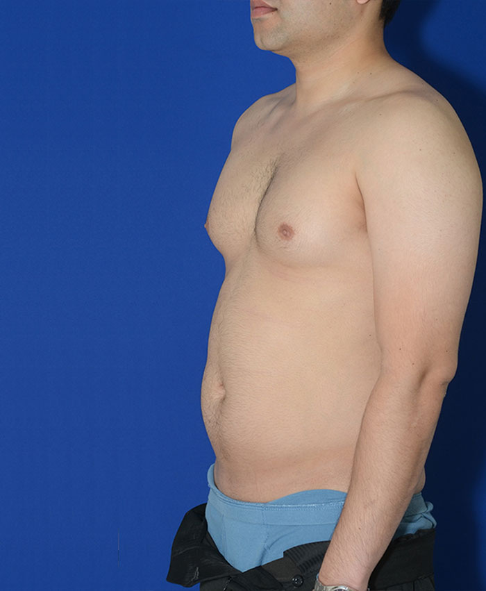 Liposuction Before & After Photo #5