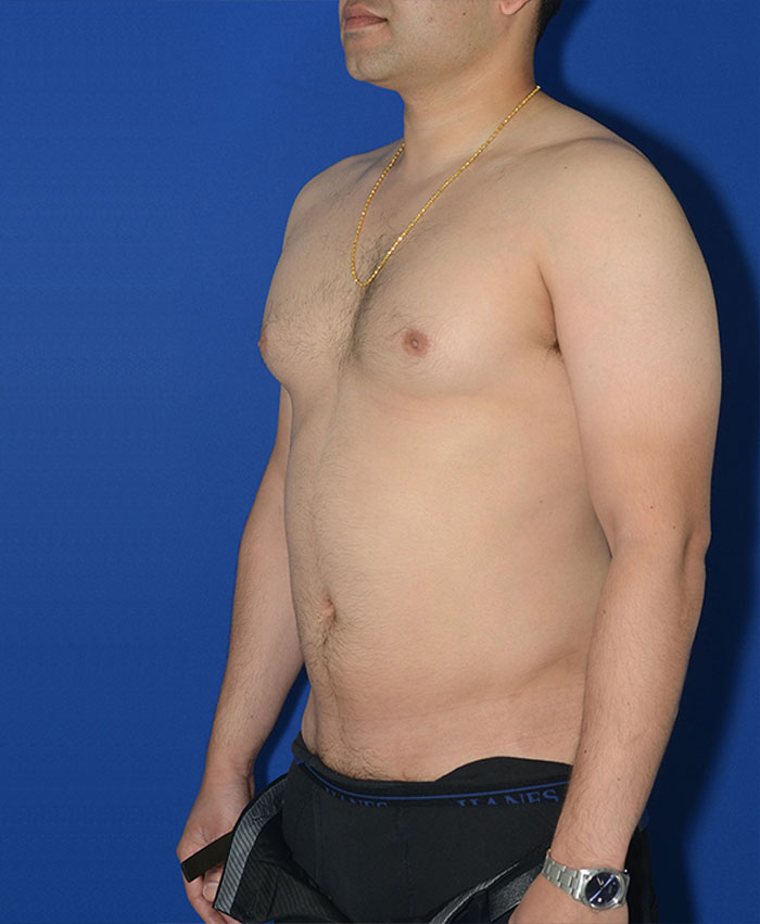 Liposuction Before & After Photo #6