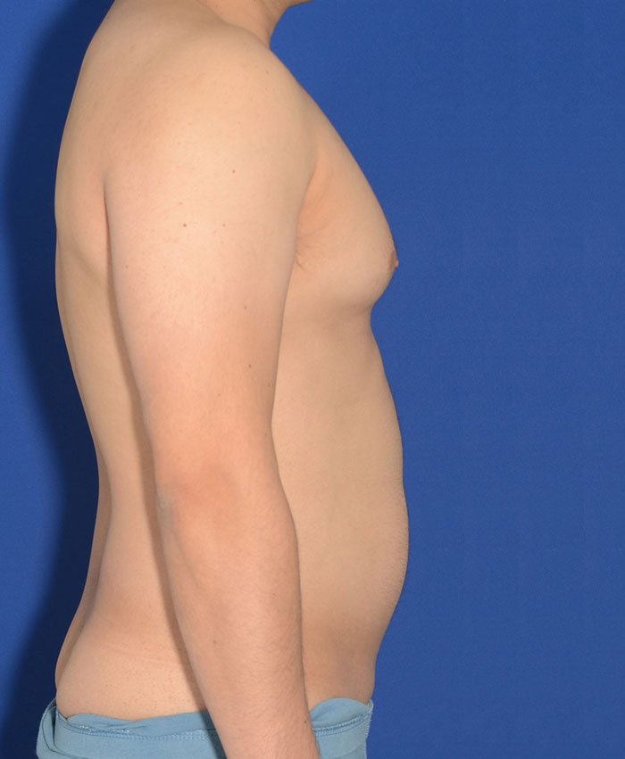 Liposuction Before & After Photo #7