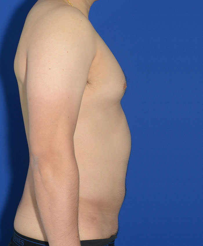Liposuction Before & After Photo #8