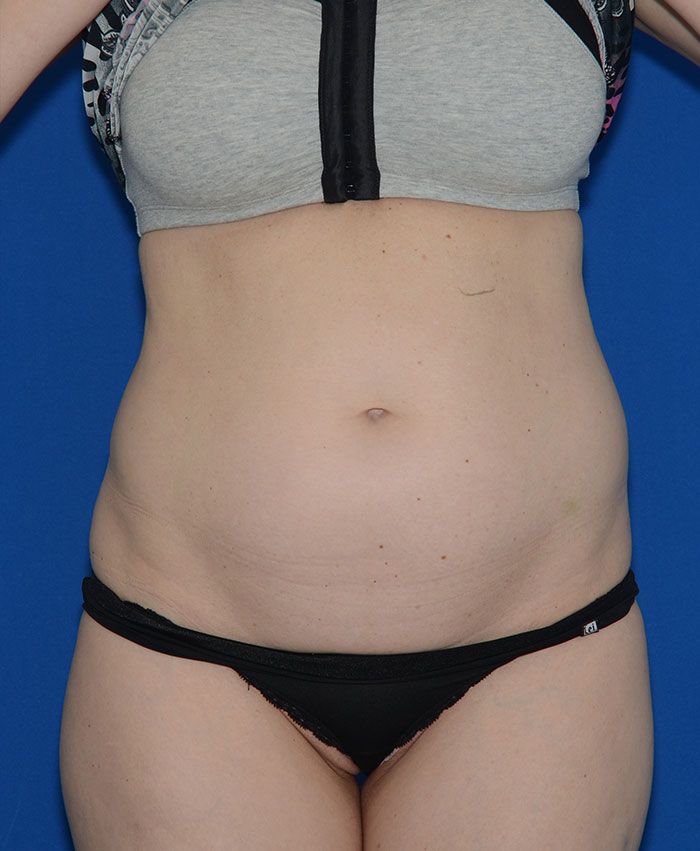 Liposuction Before & After Photo #1