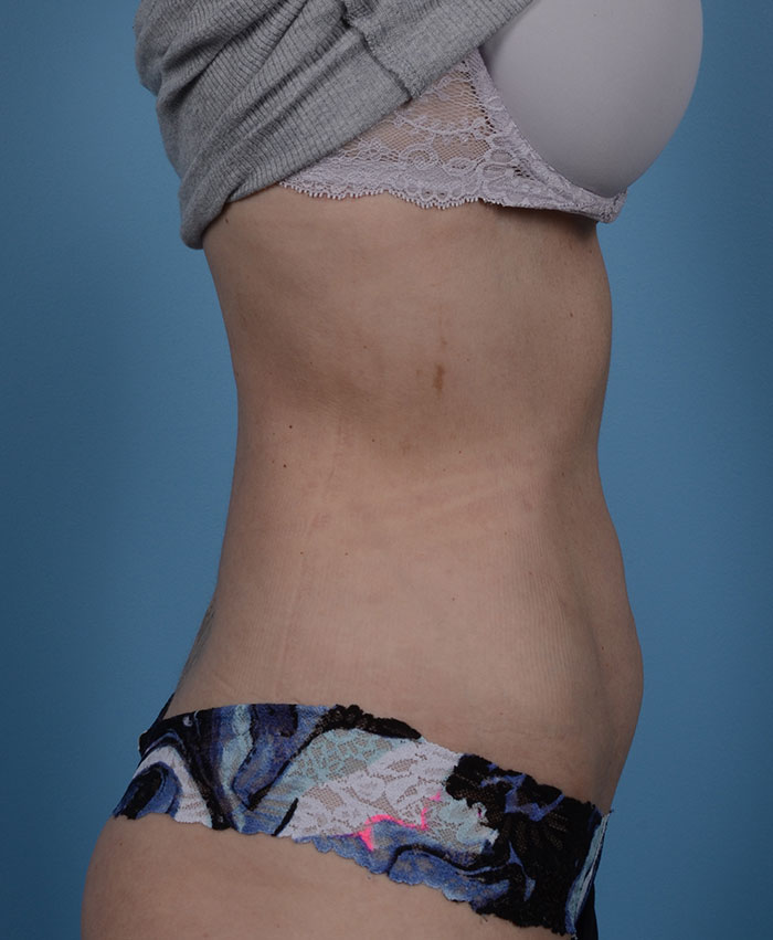 Liposuction Before & After Photo #10