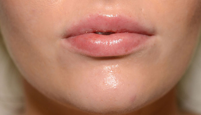 Lips Before & After Photo #2
