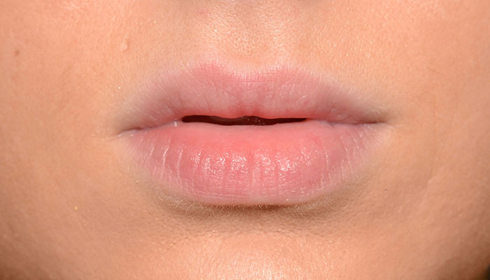 Lips Before & After Photo #1