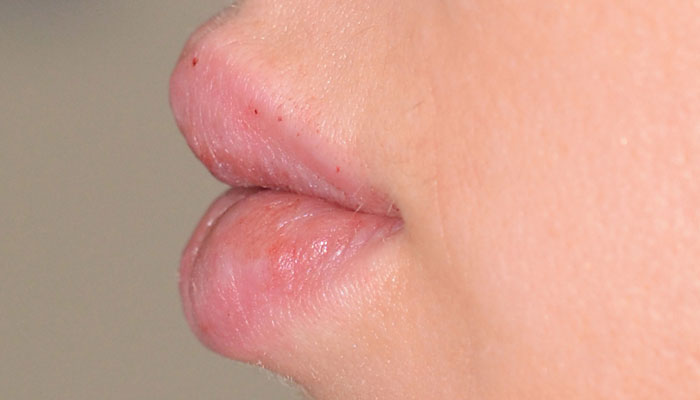 Lips Before & After Photo #4