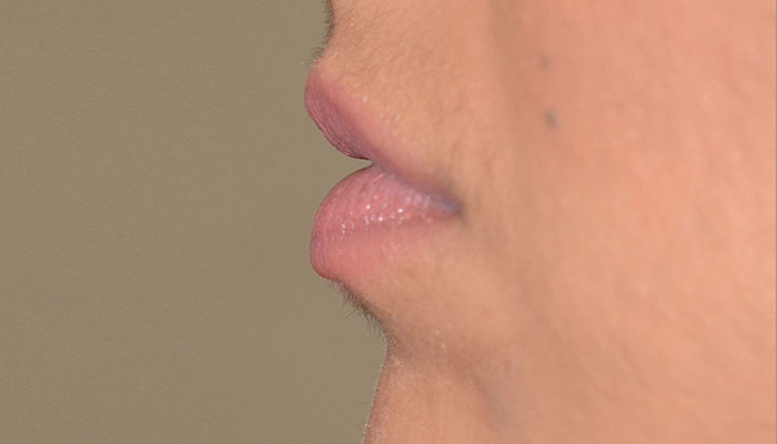 Lips Before & After Photo #3
