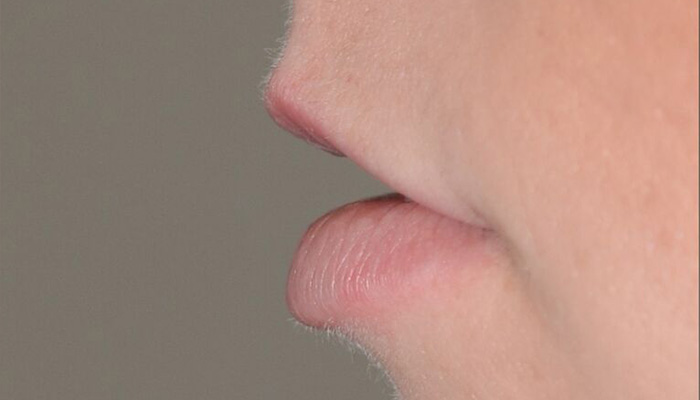 Lips Before & After Photo #3