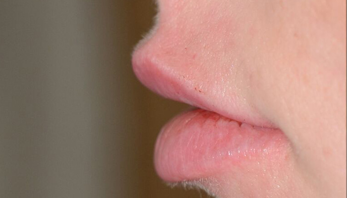 Lips Before & After Photo #4