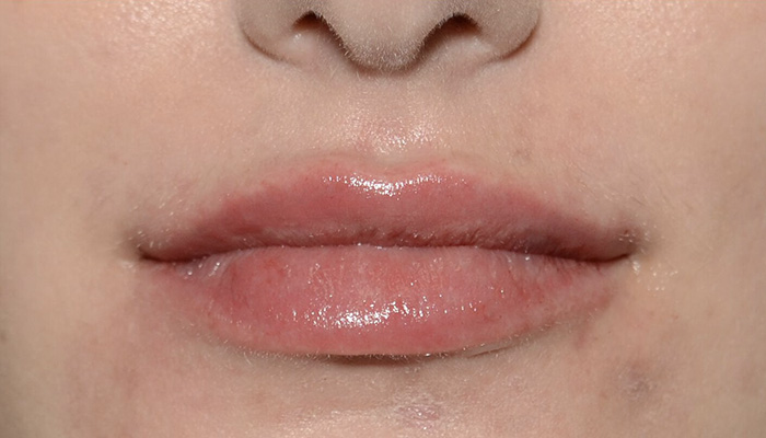 Lips Before & After Photo #2