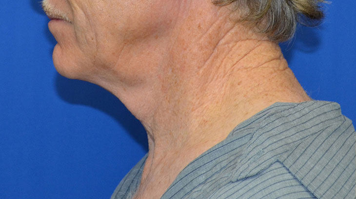 Neck Lift Before & After Photo #3