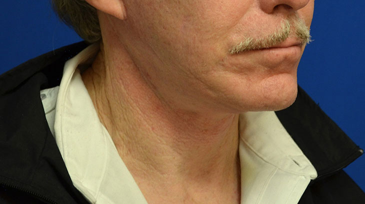 Neck Lift Before & After Photo #10
