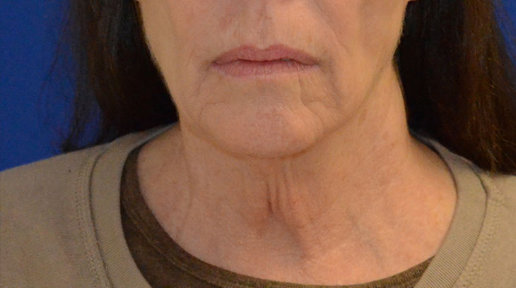 Neck Lift Before & After Photo #1