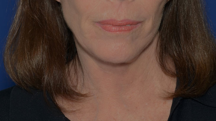 Neck Lift Before & After Photo #2