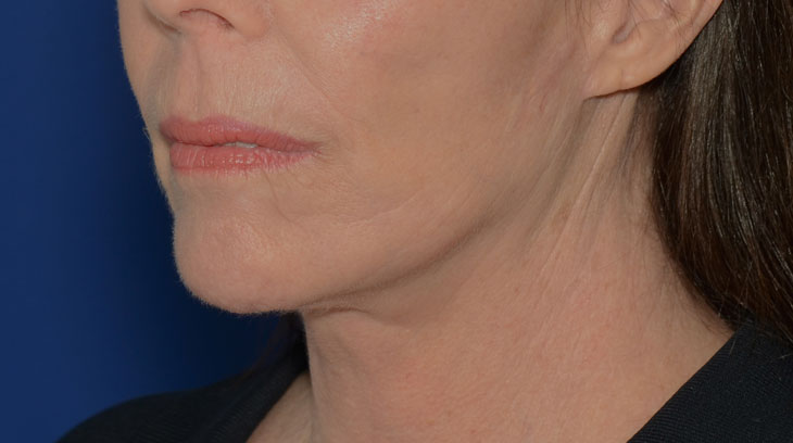 Neck Lift Before & After Photo #6