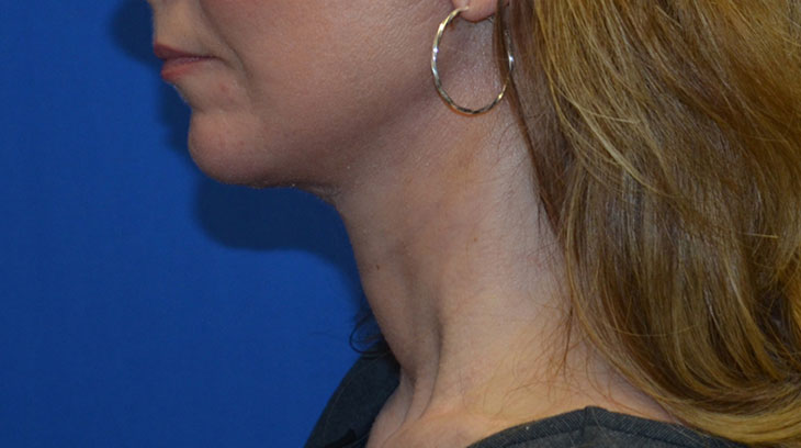 Neck Lift Before & After Photo #4