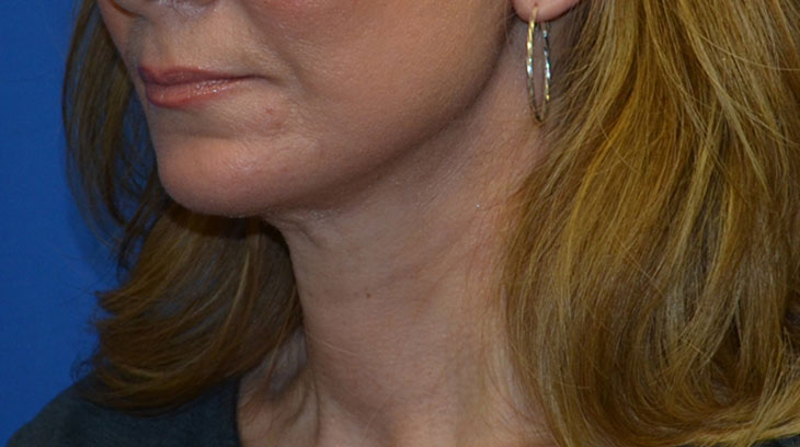Neck Lift Before & After Photo #6