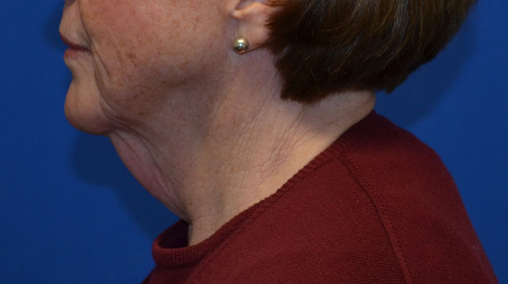 Neck Lift Before & After Photo #3