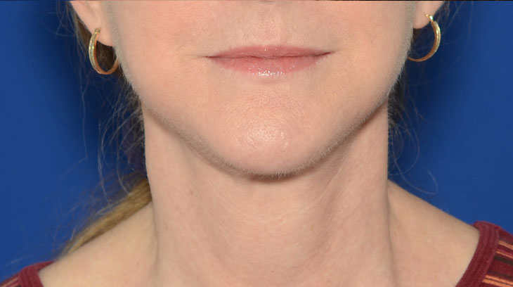 Neck Lift Before & After Photo #2