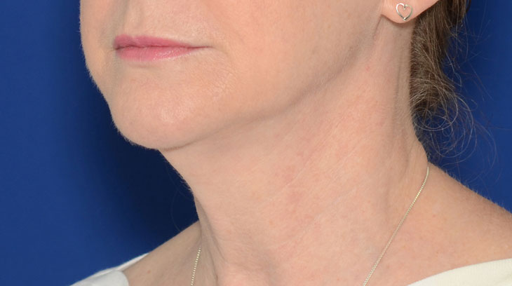 Neck Lift Before & After Photo #5
