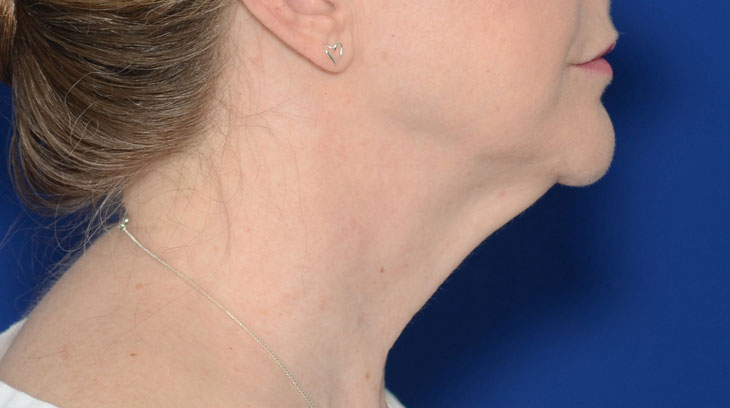 Neck Lift Before & After Photo #7