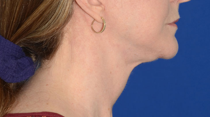 Neck Lift Before & After Photo #8