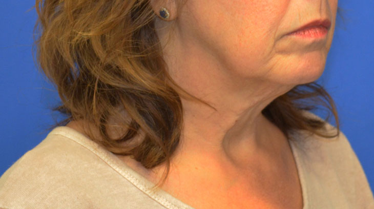 Neck Lift Before & After Photo #9