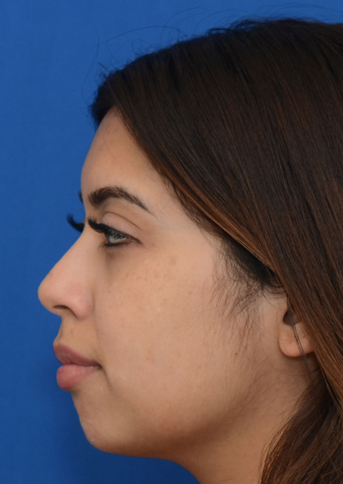 Non Surgical Chin Augmentation Before & After Photo #6