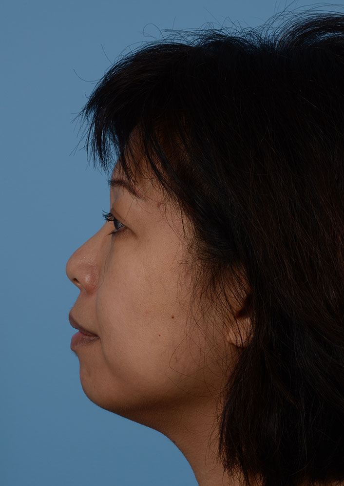 Non Surgical Chin Augmentation Before & After Photo #3