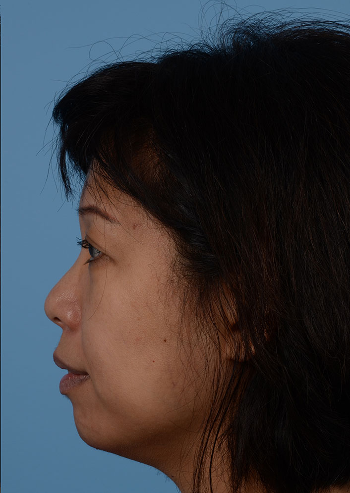 Non Surgical Chin Augmentation Before & After Photo #4