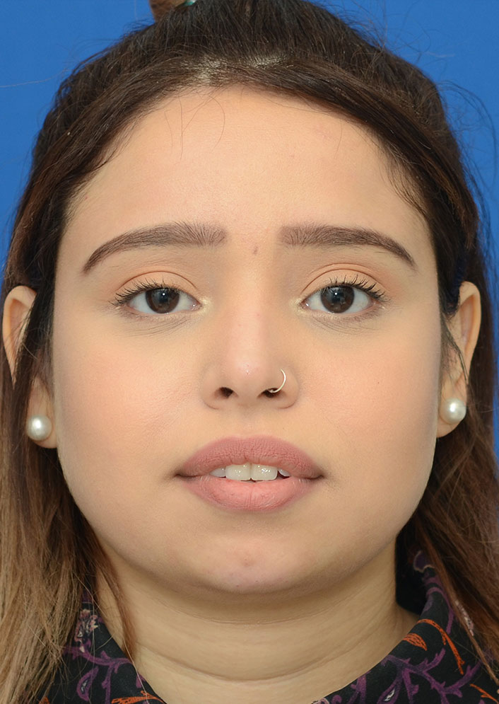 Non Surgical Rhinoplasty Before & After Photo #2