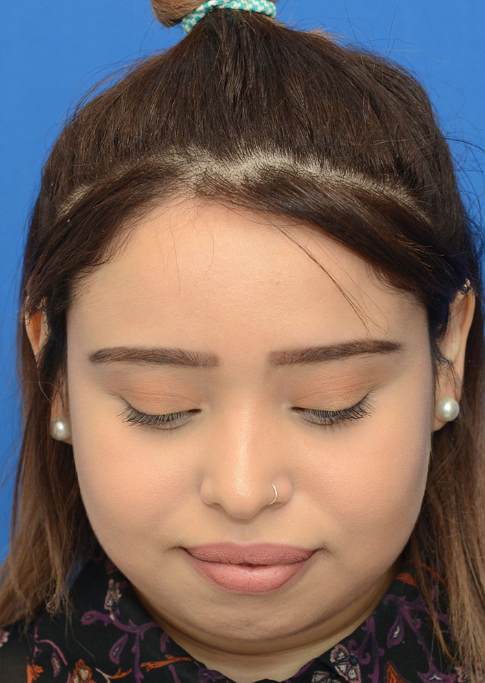 Non Surgical Rhinoplasty Before & After Photo #3