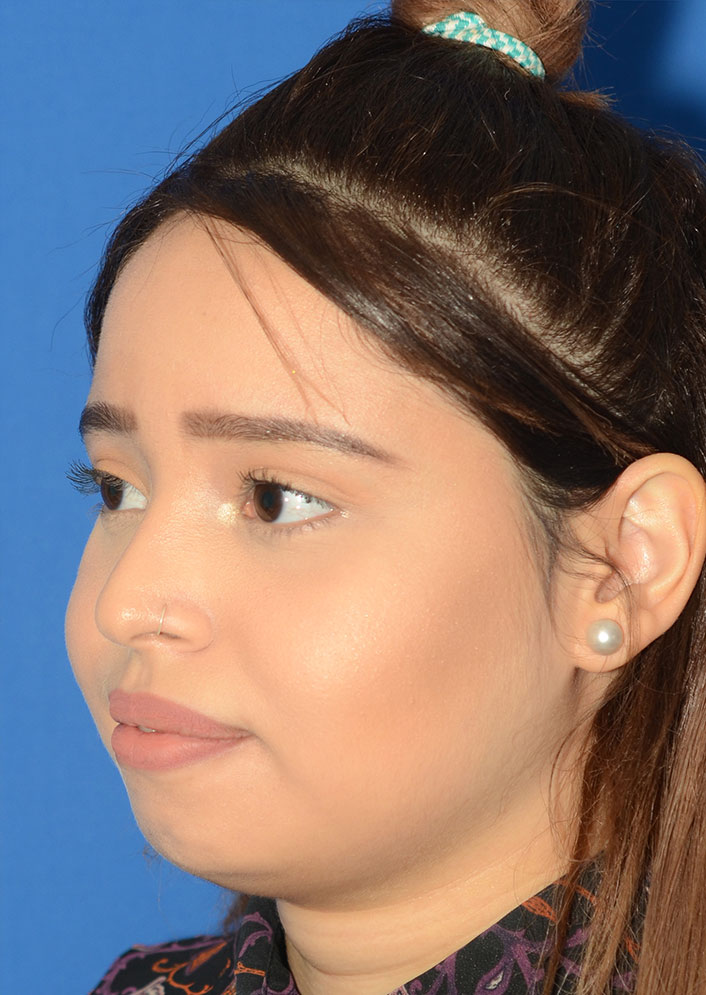 Non Surgical Rhinoplasty Before & After Photo #5