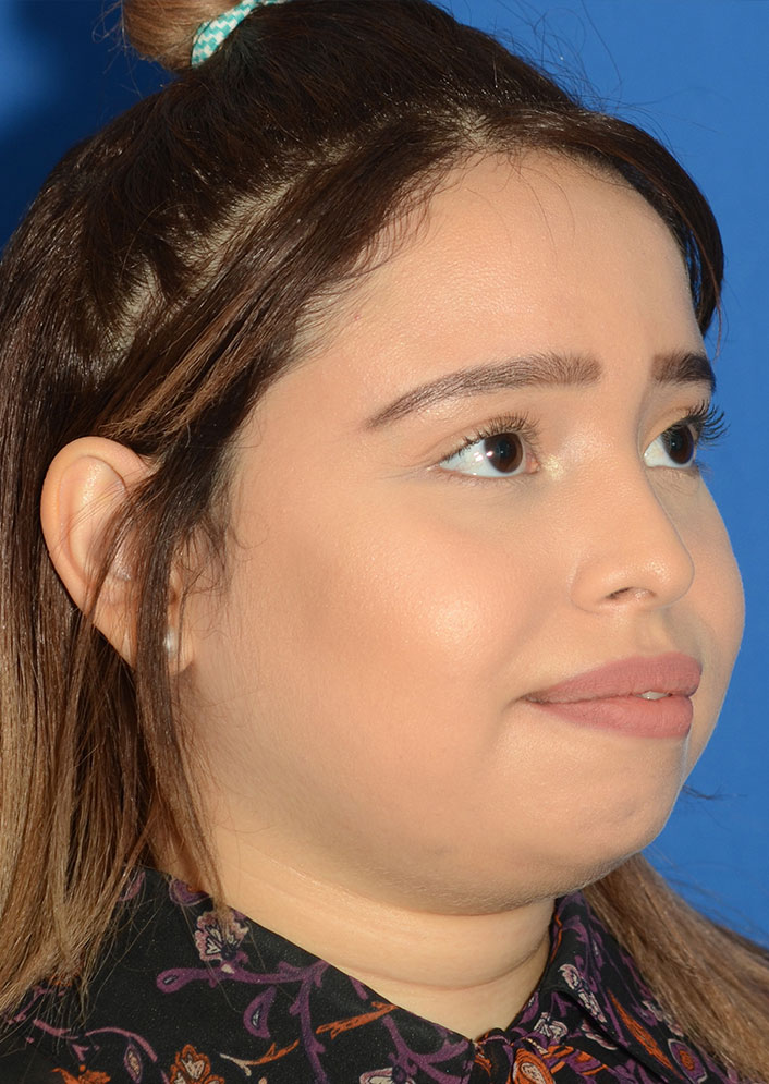 Non Surgical Rhinoplasty Before & After Photo #9