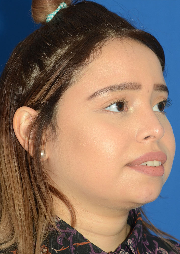 Non Surgical Rhinoplasty Before & After Photo #10
